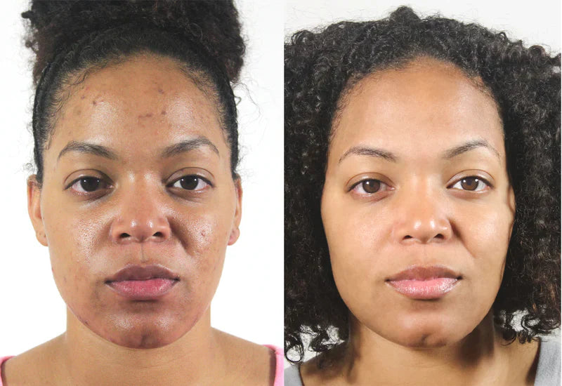 The 5 Surprising Benefits of Blemiviv Exfoliating Scrub: