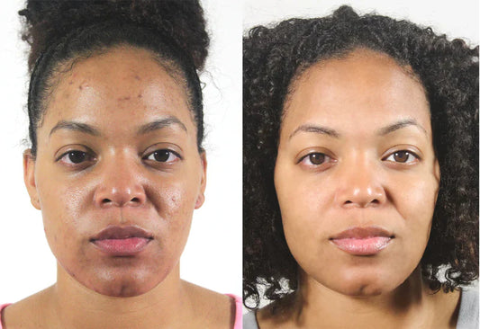 The 5 Surprising Benefits of Blemiviv Exfoliating Scrub: